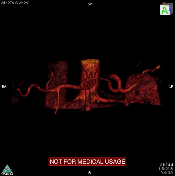 File:Celiac trunk variant anatomy - gastrohepatic trunk and splenic artery (Radiopaedia 38815-40995 B 13).jpg