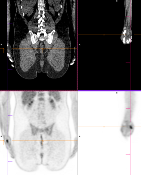 File:Cell phone usage artifact on PET-CT (Radiopaedia 72470-83000 B 1).PNG