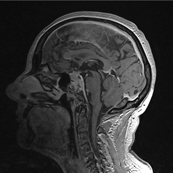 File:Central base of skull meningioma (Radiopaedia 53531-59549 Sagittal T1 C+ 25).jpg