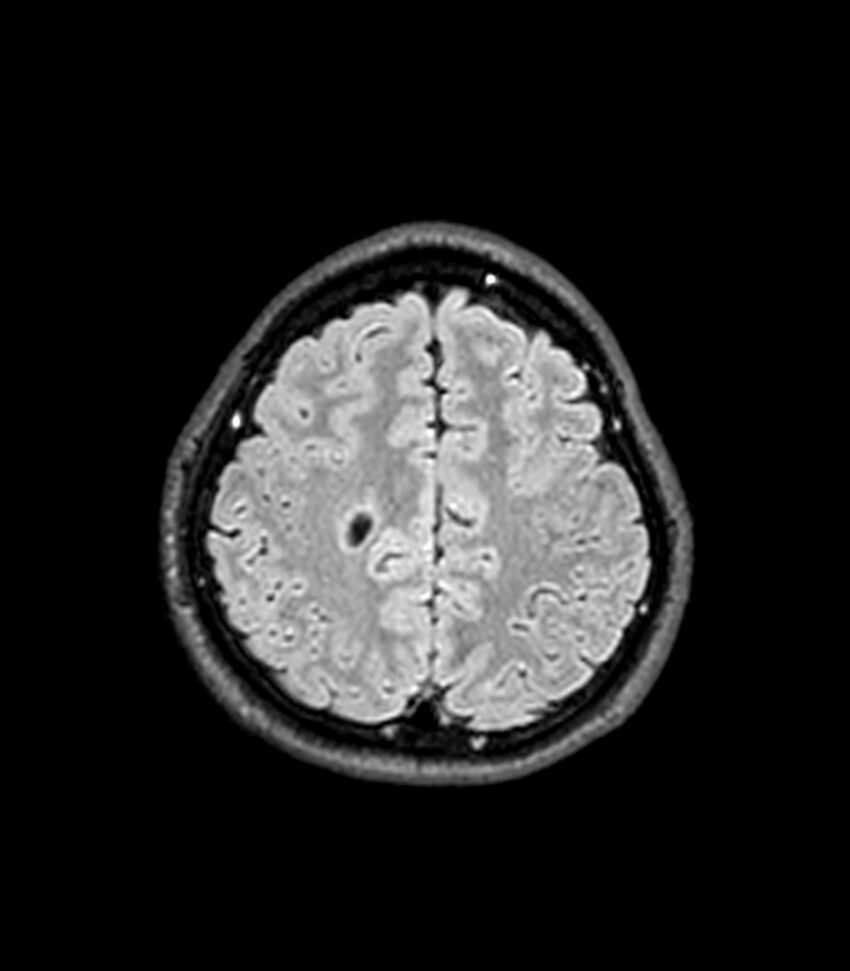 Central neurocytoma (Radiopaedia 79320-92380 Axial FLAIR 81).jpg