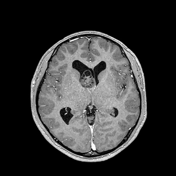 File:Central neurocytoma (Radiopaedia 79320-92380 Axial T1 C+ 124).jpg