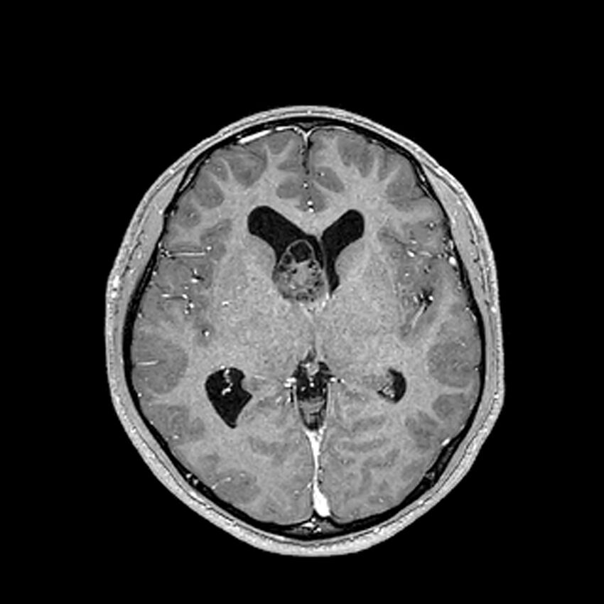 Central neurocytoma (Radiopaedia 79320-92380 Axial T1 C+ 124).jpg