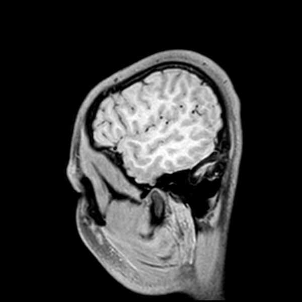 File:Central neurocytoma (Radiopaedia 79320-92380 Sagittal T1 45).jpg