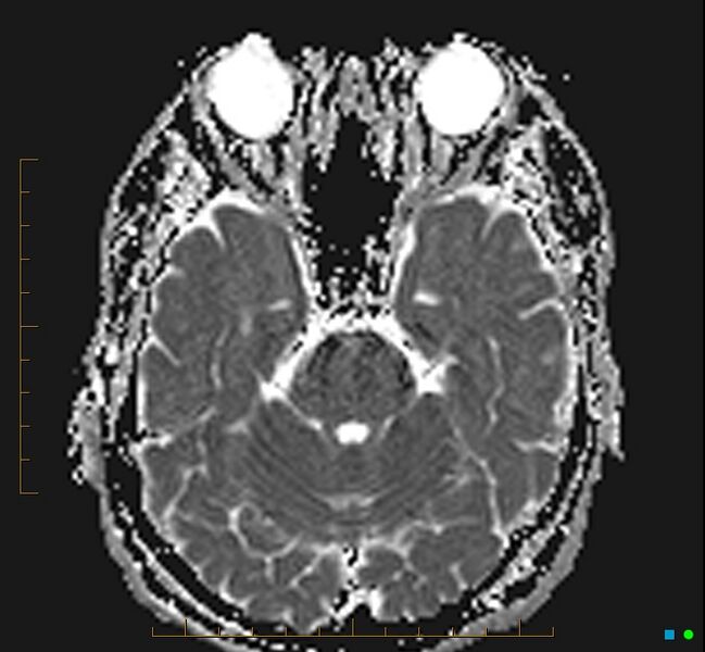 File:Cerebellar gangliocytoma (Radiopaedia 65377-74422 Axial ADC 12).jpg