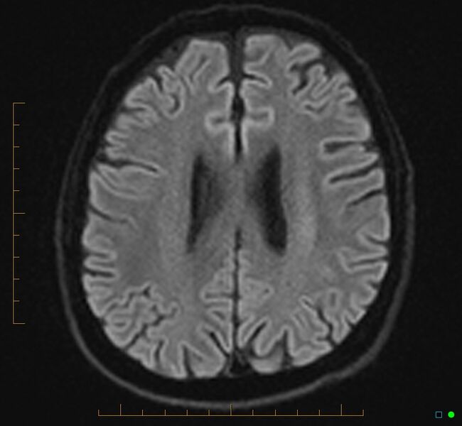 File:Cerebellar gangliocytoma (Radiopaedia 65377-74422 Axial DWI 26).jpg