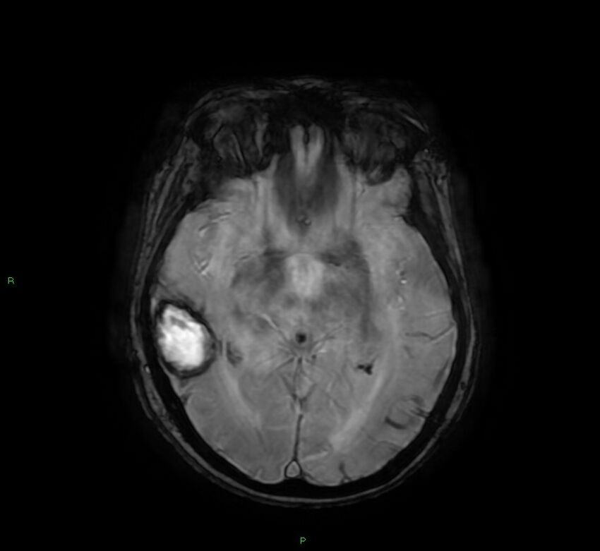 Cerebral amyloid angiopathy-associated lobar intracerebral hemorrhage (Radiopaedia 58378-65517 Axial SWI 33).jpg