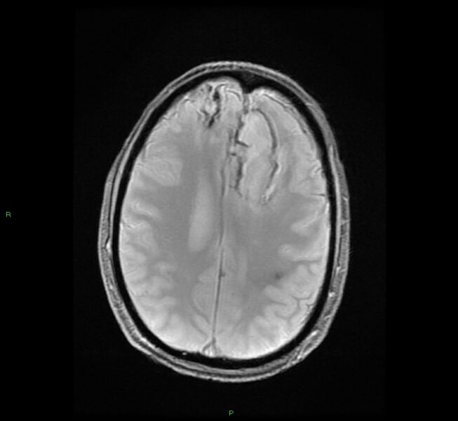 File:Cerebral amyloid angiopathy-associated lobar intracerebral hemorrhage (Radiopaedia 58529-65684 Axial Gradient Echo 18).jpg