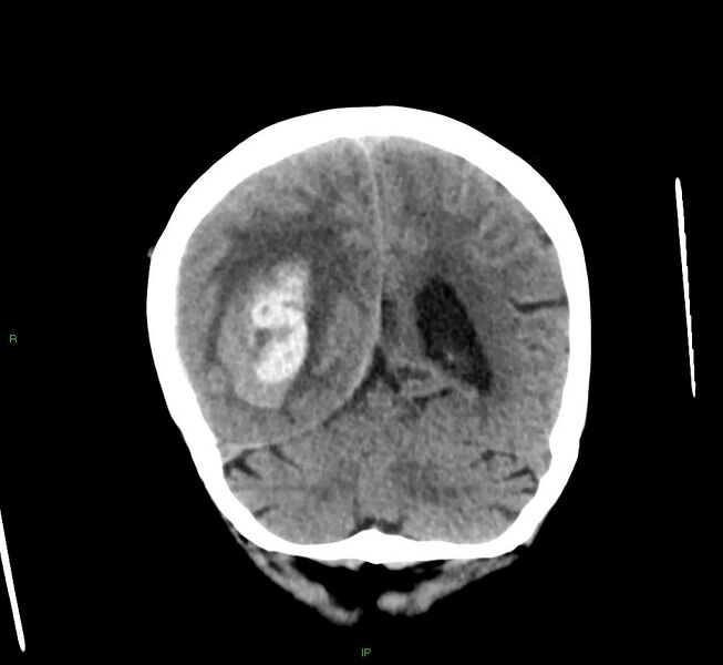 File:Cerebral amyloid angiopathy-associated lobar intracerebral hemorrhage (Radiopaedia 58563-65727 Coronal non-contrast 22).jpg