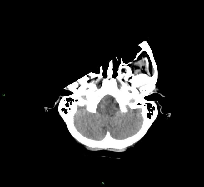 File:Cerebral amyloid angiopathy-associated lobar intracerebral hemorrhage (Radiopaedia 58754-65975 Axial non-contrast 50).jpg