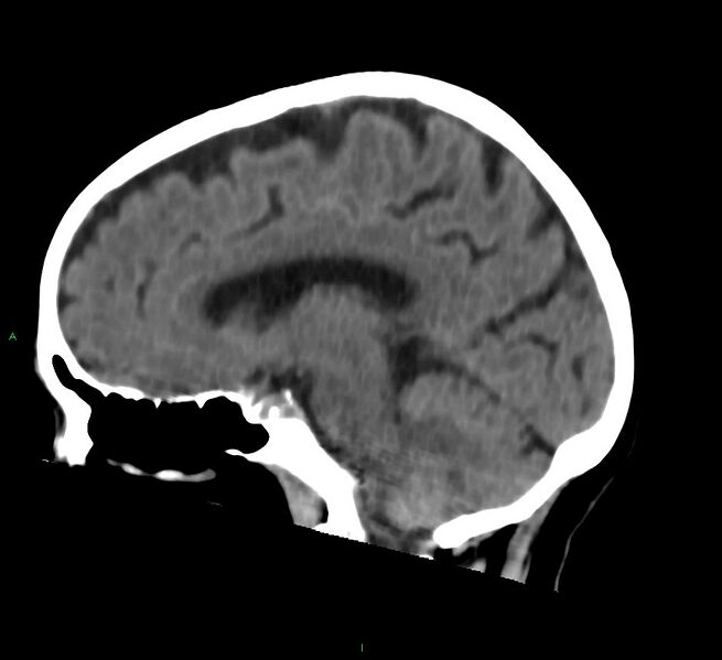 File:Cerebral amyloid angiopathy-associated lobar intracerebral hemorrhage (Radiopaedia 58757-65978 C 25).jpg