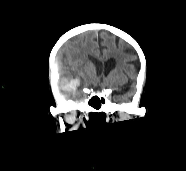 File:Cerebral amyloid angiopathy-associated lobar intracerebral hemorrhage (Radiopaedia 58758-65980 Coronal non-contrast 41).jpg