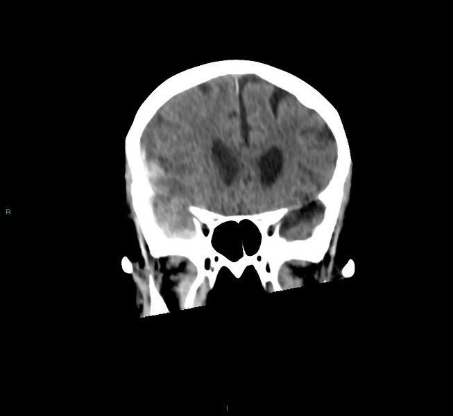 File:Cerebral amyloid angiopathy-associated lobar intracerebral hemorrhage (Radiopaedia 58758-65980 Coronal non-contrast 44).jpg