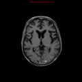 Cerebral and orbital tuberculomas (Radiopaedia 13308-13311 Axial T1 C+ 11).jpg
