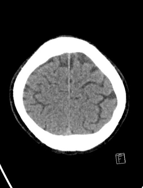 File:Cerebral arteriovenous malformation (Radiopaedia 78188-90745 Axial non-contrast 21).jpg