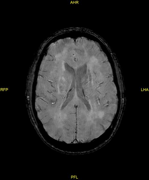 File:Cerebral autosomal dominant arteriopathy with subcortical infarcts and leukoencephalopathy (CADASIL) (Radiopaedia 86108-102054 Axial SWI 65).jpg