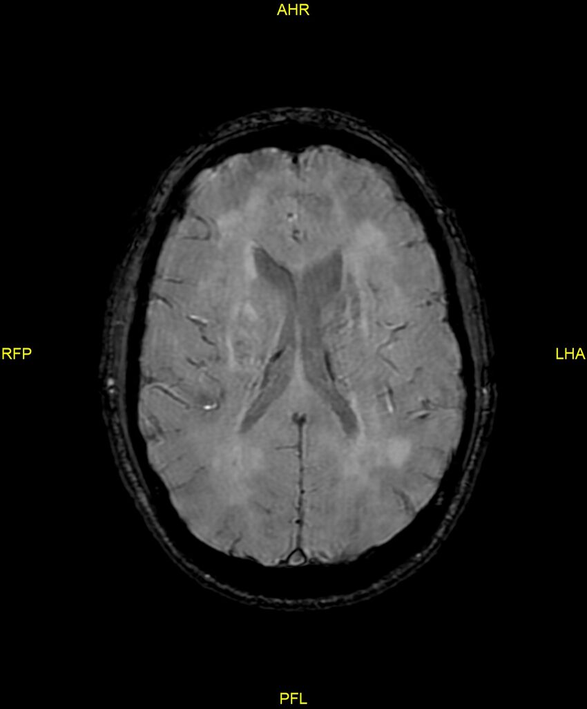 Cerebral autosomal dominant arteriopathy with subcortical infarcts and leukoencephalopathy (CADASIL) (Radiopaedia 86108-102054 Axial SWI 65).jpg