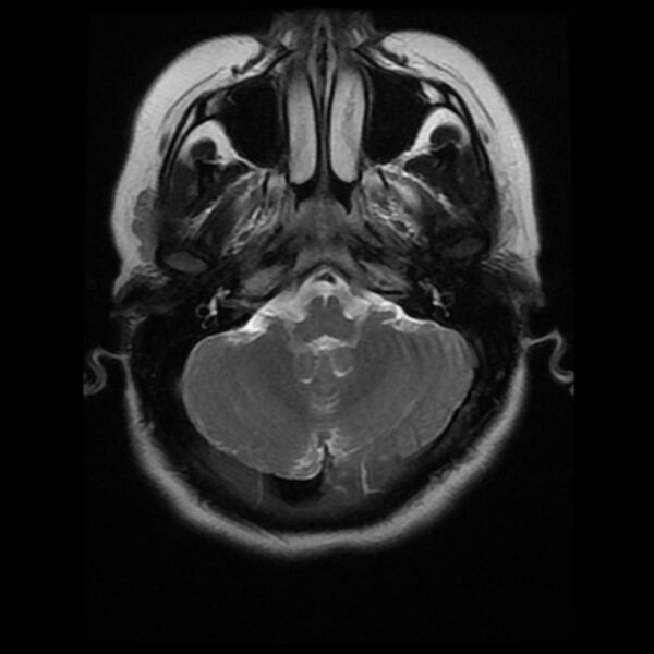 File:Cerebral cavernous malformation (Radiopaedia 44301-47942 Axial T2 5).jpg