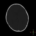 Cerebral contusion (Radiopaedia 48869-53911 Axial bone window 10).jpg