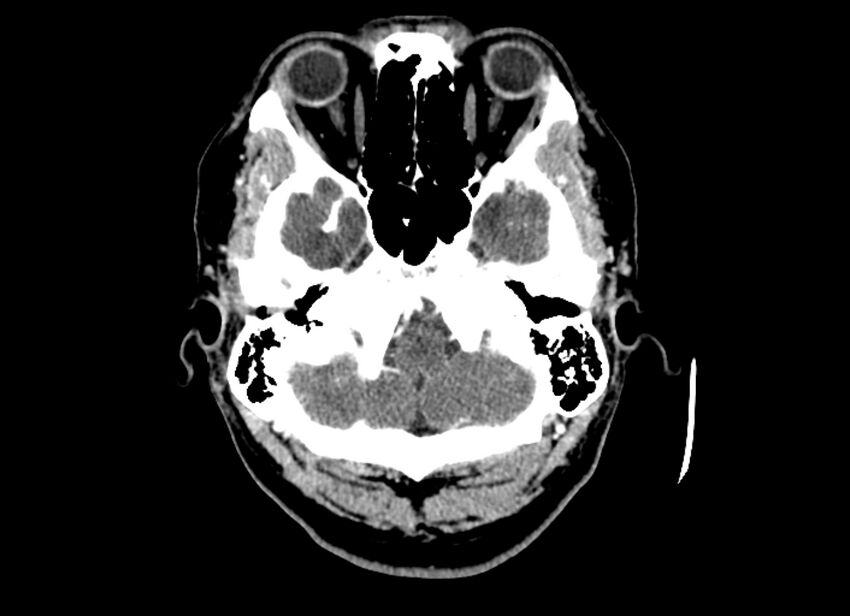 Cerebral edema (Radiopaedia 82519-96661 B 48).jpg