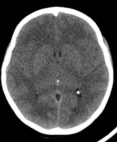 File:Cerebral edema due to severe hyponatremia (Radiopaedia 89826-106937 Axial non-contrast 45).jpg