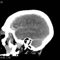 Cerebral hemorrhagic contusion with subdural and subarachnoid hemorrhage (Radiopaedia 10680-11146 C 19).jpg