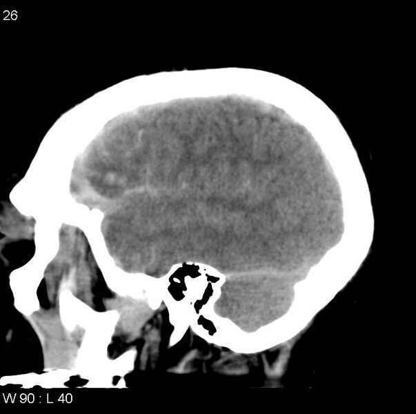 File:Cerebral hemorrhagic contusion with subdural and subarachnoid hemorrhage (Radiopaedia 10680-11146 C 19).jpg