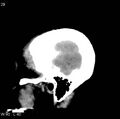 Cerebral hemorrhagic contusion with subdural and subarachnoid hemorrhage (Radiopaedia 10680-11146 C 22).jpg