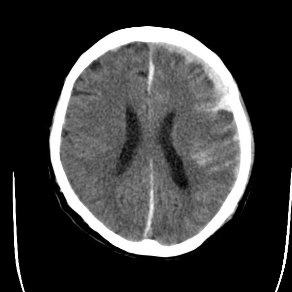 File:Cerebral hemorrhagic contusions (Radiopaedia 23145-23188 Axial non-contrast 25).jpg