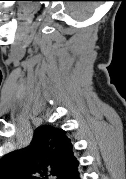 File:Cerebral hemorrhagic contusions and cervical spine fractures (Radiopaedia 32865-33841 G 83).jpg