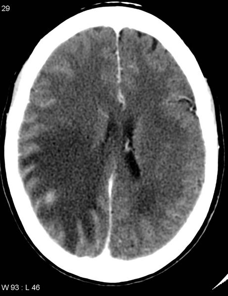 File:Cerebral metastasis - lung cancer (Radiopaedia 5315-7072 Axial C+ delayed 5).jpg