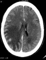 Cerebral metastasis - lung cancer (Radiopaedia 5315-7072 Axial C+ delayed 5).jpg