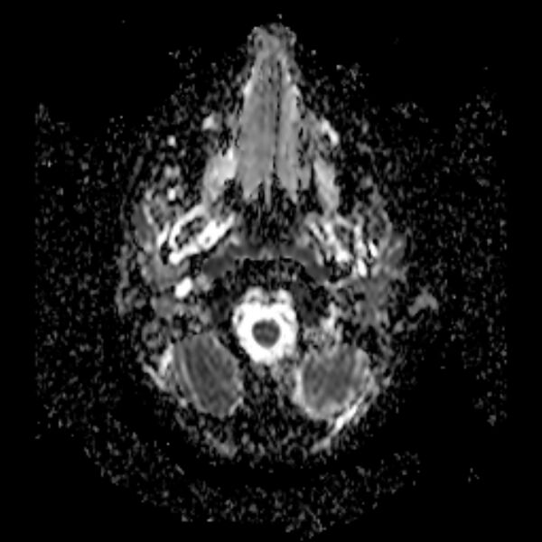 File:Cerebral tuberculoma (Radiopaedia 41152-43932 Axial ADC 1).jpg