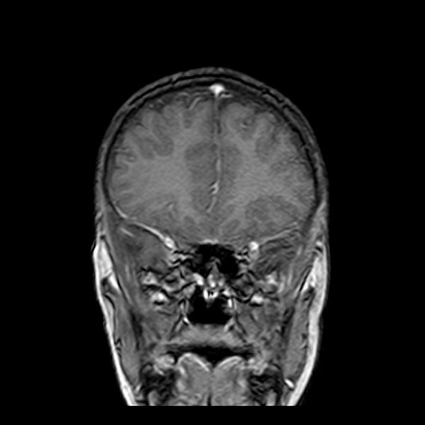 File:Cerebral tuberculoma (Radiopaedia 41152-43932 Coronal T1 C+ 4).jpg