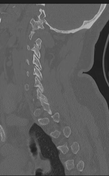 File:Cervical canal stenosis - OPLL and osteophytes (Radiopaedia 47329-51910 Sagittal bone window 53).png