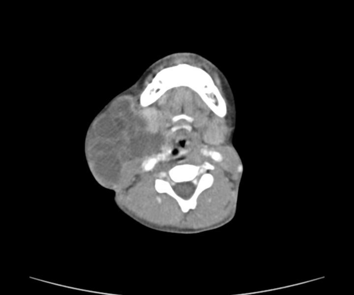 File:Cervical cystic lymphangioma (Radiopaedia 63655-72332 Axial + contrast 16).jpg