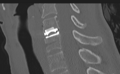 Cervical disc replacement (Radiopaedia 37383-39205 Sagittal bone window 40).png