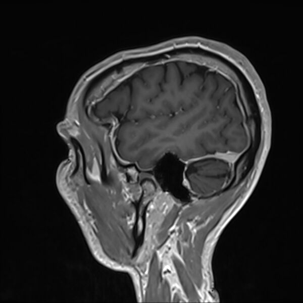 File:Cervical dural CSF leak on MRI and CT treated by blood patch (Radiopaedia 49748-54995 G 104).jpg