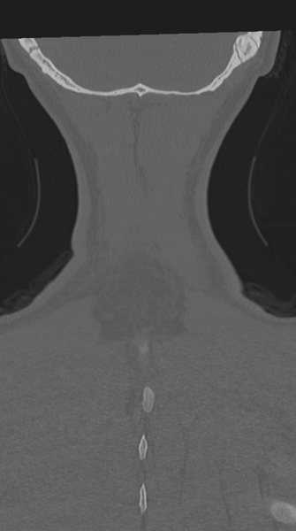 File:Cervical intercalary bone (Radiopaedia 35211-36748 Coronal bone window 75).png