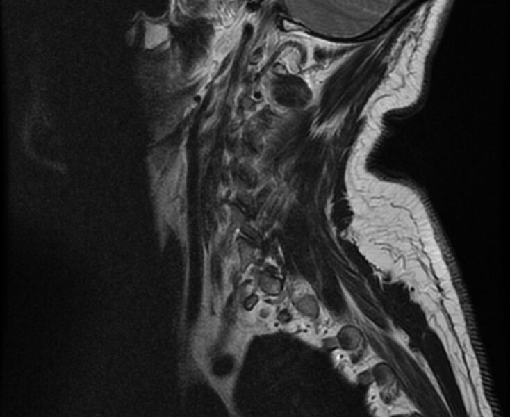 File:Cervical schwannoma (Radiopaedia 72399-82934 Sagittal T2 2).jpg