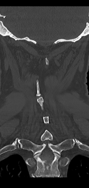 File:Cervical spine fracture - chalk stick (Radiopaedia 39116-41323 Coronal bone window 40).png