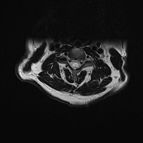 File:Cervical tumor-like myelopathy due to Type V dAVF (Radiopaedia 82461-96604 Axial T2 14).jpg