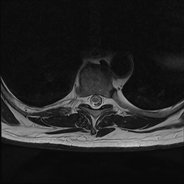 File:Cervical tumor-like myelopathy due to Type V dAVF (Radiopaedia 82461-96604 D 32).jpg