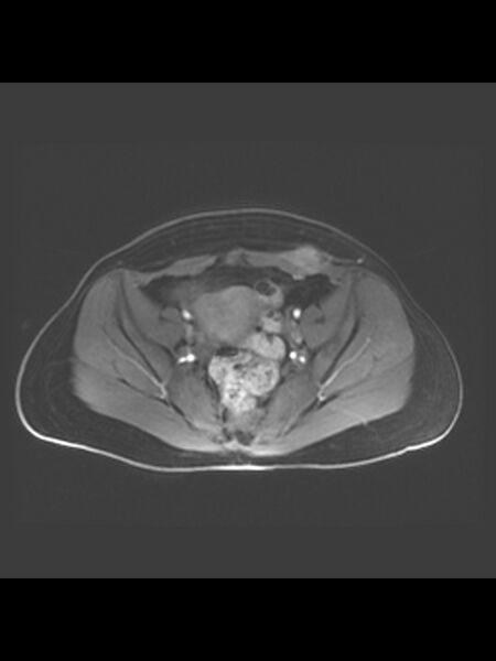 File:Cesarean section scar endometrioma (Radiopaedia 56569-63297 Axial T1 C+ fat sat 26).jpg