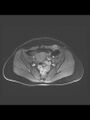 Cesarean section scar endometrioma (Radiopaedia 56569-63297 Axial T1 C+ fat sat 26).jpg