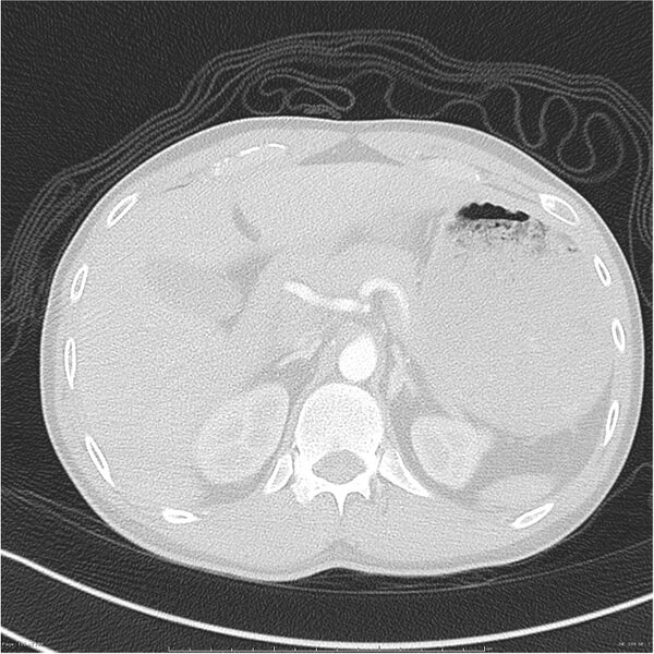 File:Chest and abdomen multi-trauma (Radiopaedia 26294-26425 lung window 106).jpg