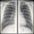 Chest x-ray - breathing (Radiopaedia 32556-33507 D 1).jpg