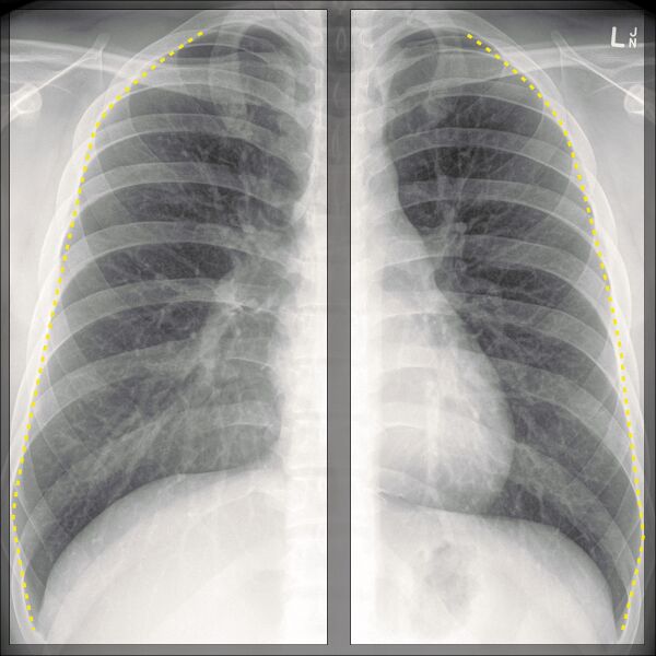 File:Chest x-ray - breathing (Radiopaedia 32556-33507 D 1).jpg