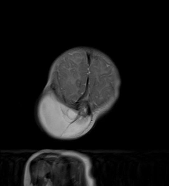 File:Chiari III malformation with occipital encephalocele (Radiopaedia 79446-92559 Coronal T2 13).jpg