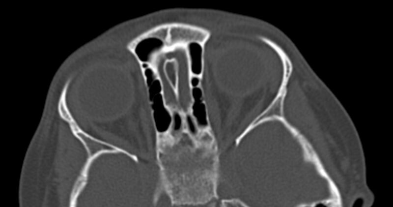 File:Choanal atresia (Radiopaedia 51295-56972 Axial bone window 50).jpg