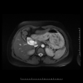 Choledochal cyst with chronic calcific pancreatitis (Radiopaedia 18245-18062 Axial T2 6).png